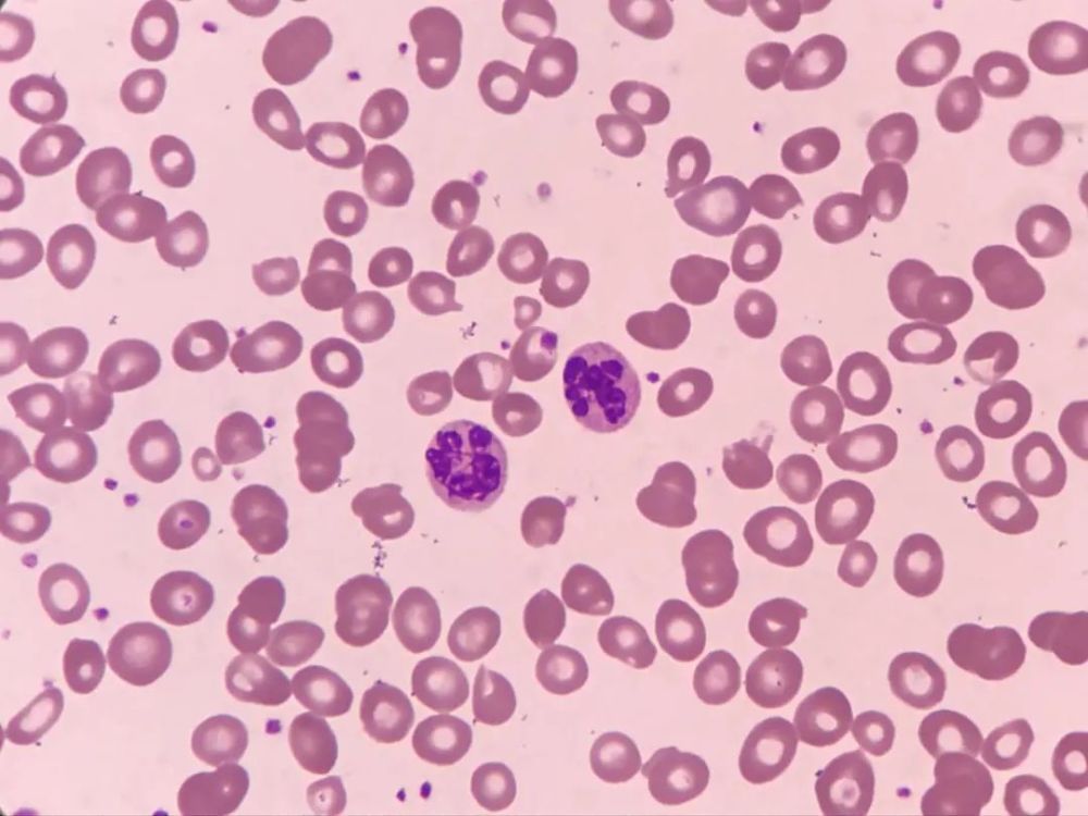 镜检可见大红细胞及较多中性粒细胞分叶过多,呈现一种核右移的表现