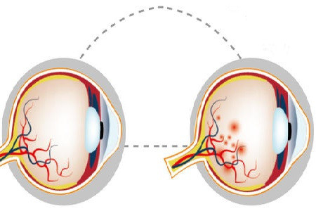 糖尿病,腎病等引起眼底的視網膜病變出血,或一些眼睛本身的問題如