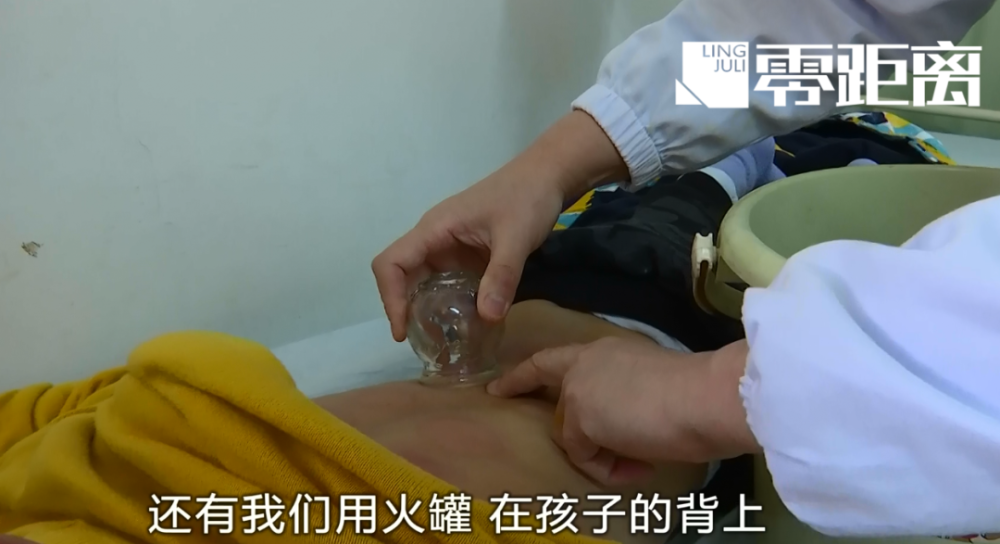 拔罐可以缓解秋冬咳嗽医生适用范围有限不可随意尝试