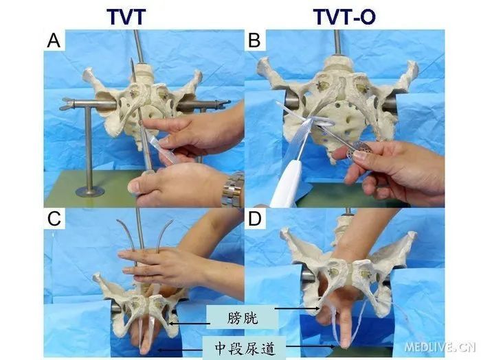 9月7日,张建勋主任在硬外麻醉下行经闭孔尿道中段无张力悬吊术(tvt-o)