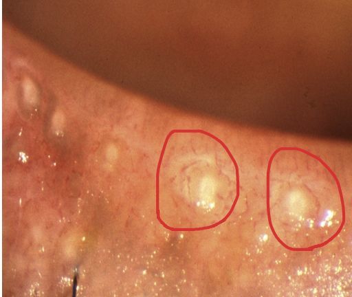 睑板腺阻塞睑板腺看到这个病的名称我们就知道肯定是一个叫"睑板腺"的