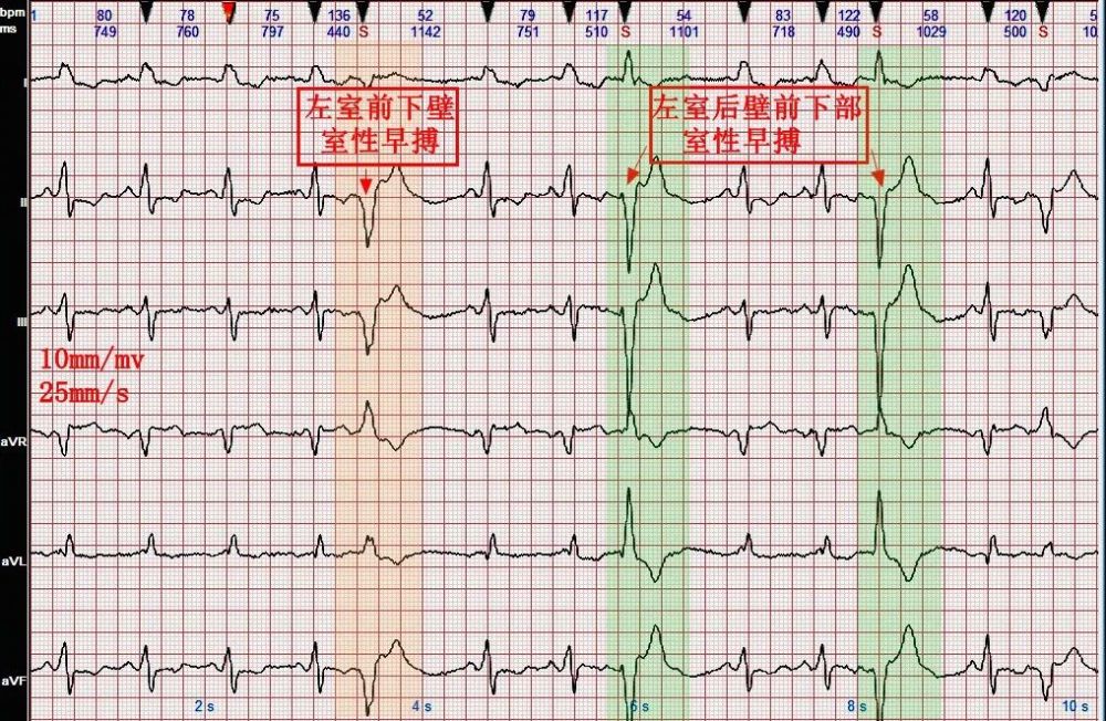 一,圖例資料[導讀] 室性早搏是臨床上最常見的心律失常之一,在人群中