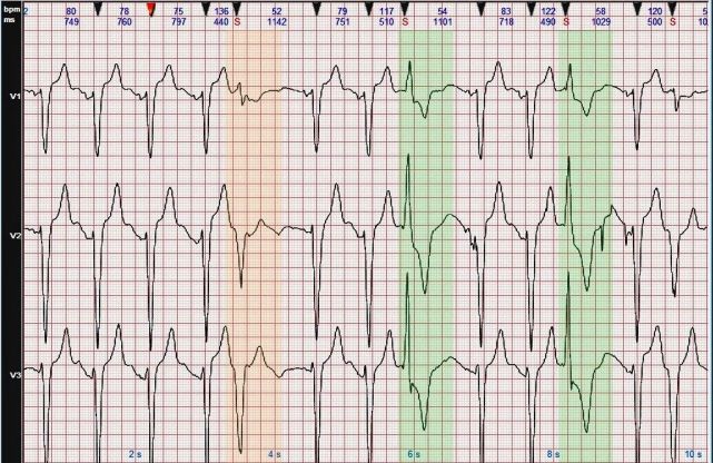 心電圖圖例分析14完全性左束支阻滯雙源性室性早搏