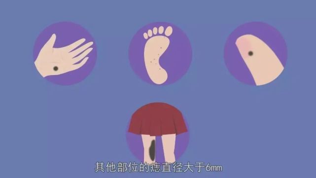 惡性黑色素瘤|癌變|黑色素瘤|色素痣|惡性腫瘤