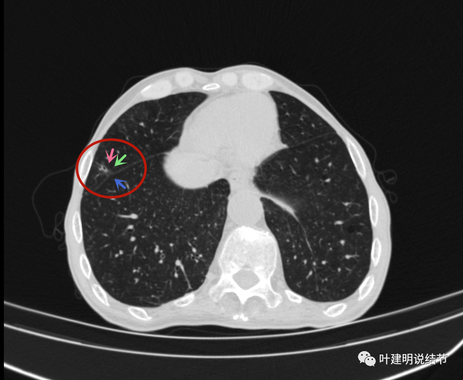 他右側也有個病灶:矢狀位見病灶密度低,輪廓較清,實性成分不明顯(此為