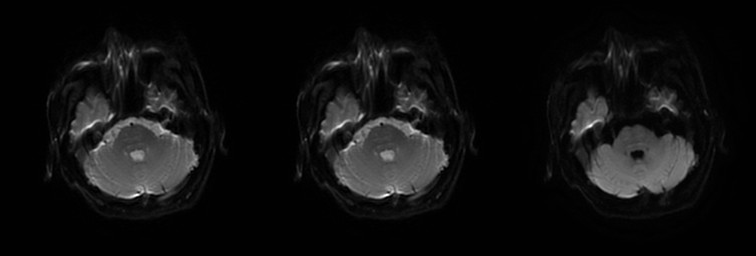 central pontine myelinosis and osmotic demyelination syndrome.