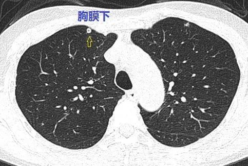 這個與血管相連的雙肺多發小結節是怎樣的神奇疾病