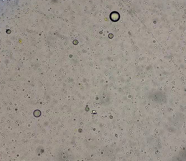 高倍镜下可见较多与红细胞大小类似或比红细胞大的脂肪球,见图3.