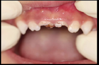 不要让你的宝宝牙坏成这个样子|乳牙|牙齿|奶瓶|小朋友