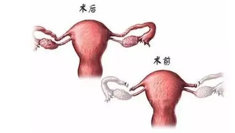 什么是输卵管复通手术?