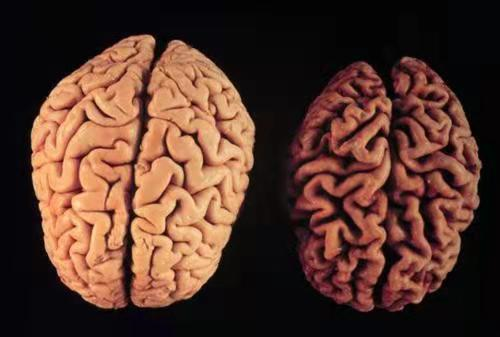 体检报告单显示老年性脑改变这是什么意思患上老年痴呆了吗