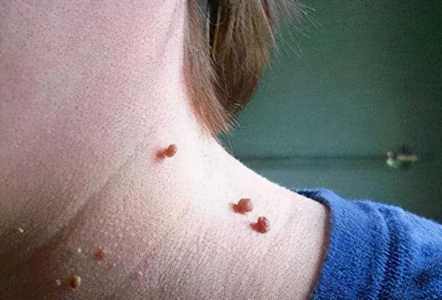 为什么没有男朋友还会感染hpv医生3件事会搞垮宫颈早戒掉