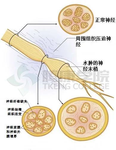 神經瘤與疼痛