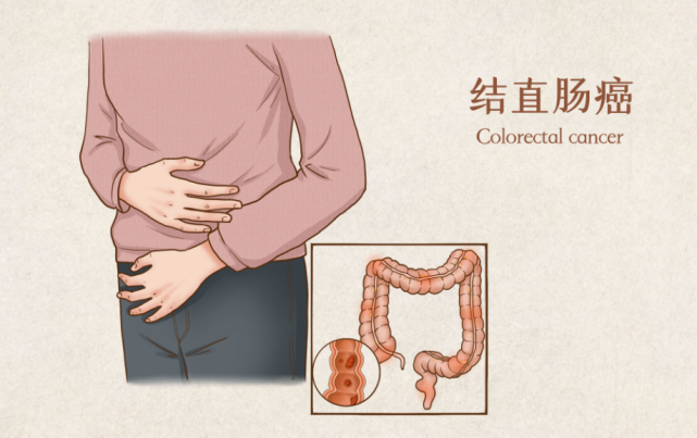 值得收藏最新最全结直肠癌诊疗流程