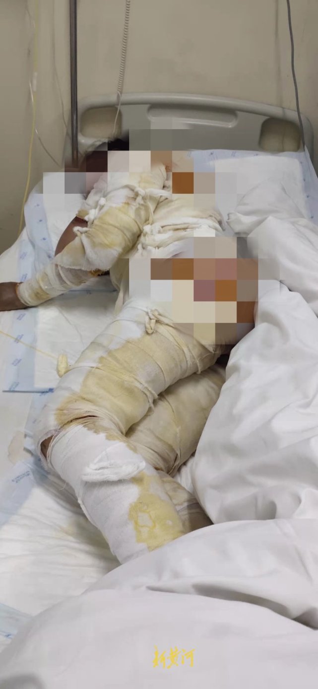 3月22日晚,陈昌雨从广东赶到了医院,见到了浑身缠满绷带,皮肤黝黑