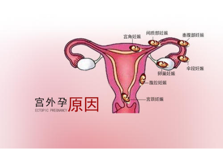 输卵管图片 宫外孕图片