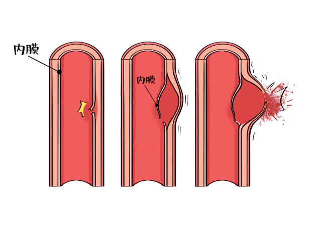 如果动脉血管壁发生分离 (内膜撕裂或其它原因),血液渗入破裂的血管壁