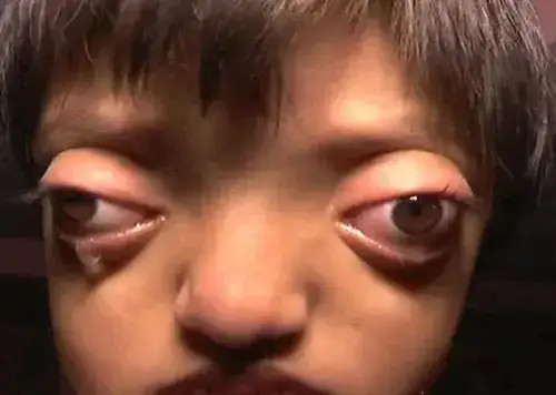 人人都想要的大眼睛这位美女却觉得像金鱼眼