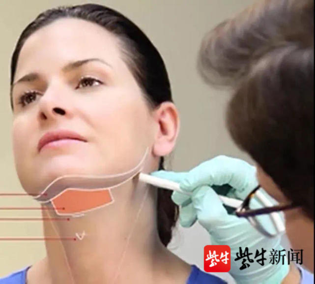 国内首支"祛双下巴针"进入Ⅲ期临床研究,你心动了吗?