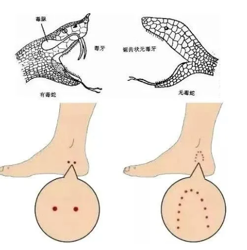 急救措施牢記:戶外被蛇咬傷,視情況決定是否需要清理傷口,如有毒蛇咬