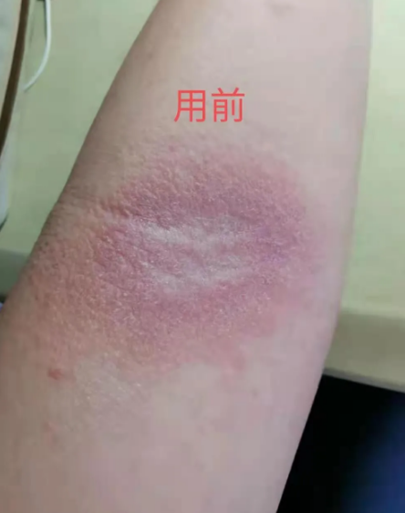 每年夏天也是在肘关节内侧长湿疹,皮炎,她用试试的心态涂抹了紫草膏