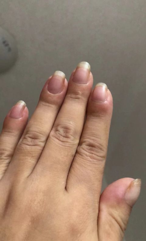 女子手指肿成萝卜头一查竟是肺癌