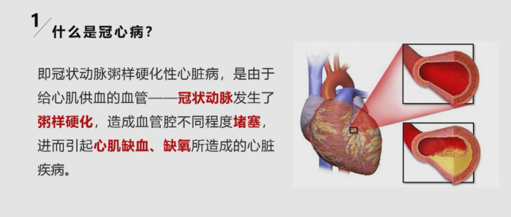 高血压,冠心病?北医三院专家带您早知道,早防治!_腾讯新闻