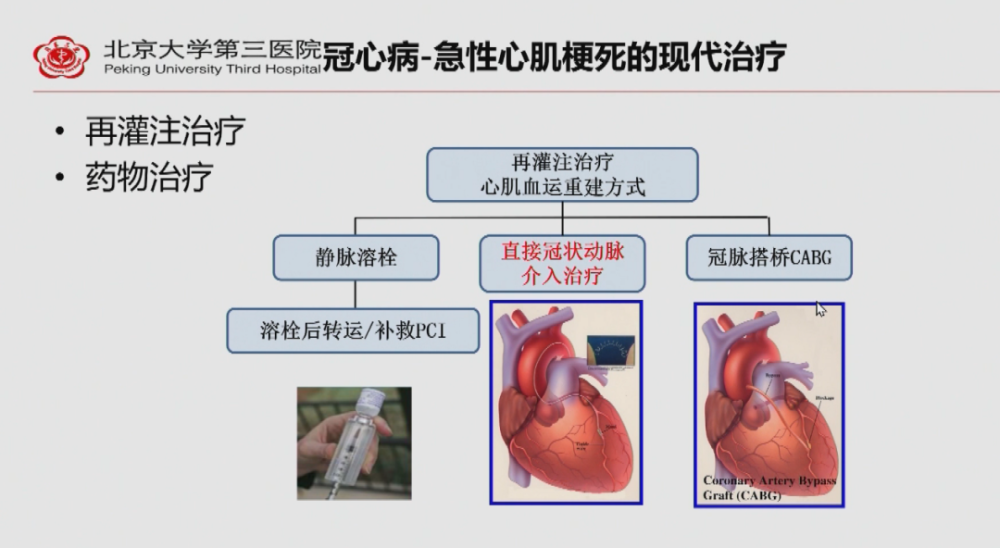 药物治疗再灌注治疗冠心病-急性心肌梗死的现代治疗冠状动脉搭桥术