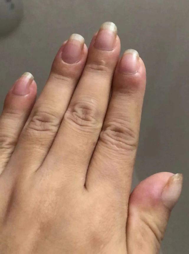 女子手指肿成萝卜头一查竟是肺癌