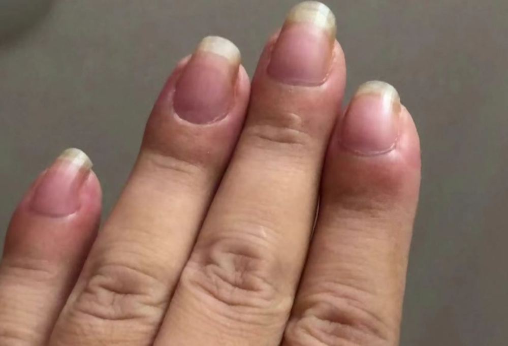 广东一女子手指肿成萝卜头一查竟是肺癌