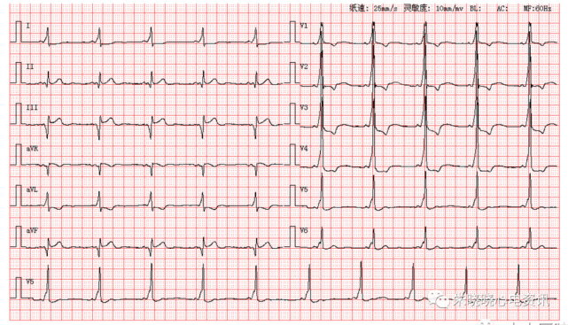 每日读图|第1574期 室性早搏二联律|室性早搏|二联律|窦性心律|心电图