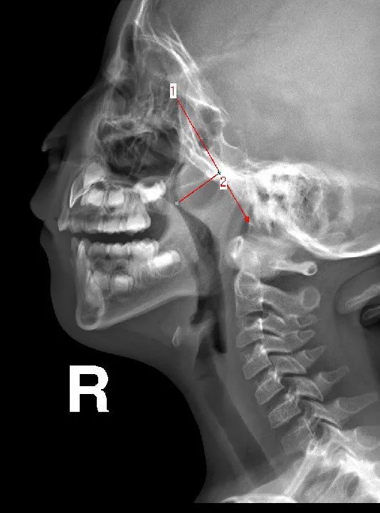 通过x线,测量【腺样体肥大】的4种方法