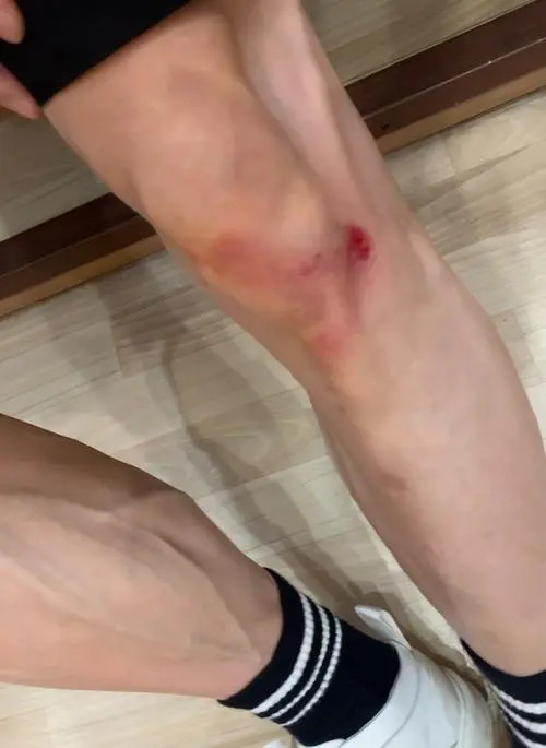 别把扭伤当小事 当心落下"内伤"-腾讯新闻