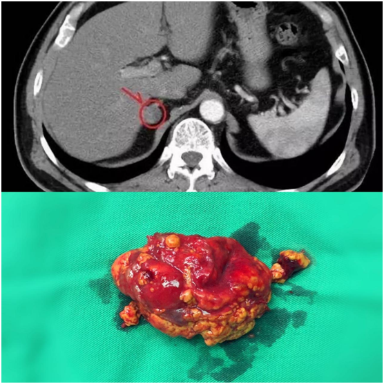 医说科普|体检发现肾上腺结节/腺瘤/增粗该怎么办?