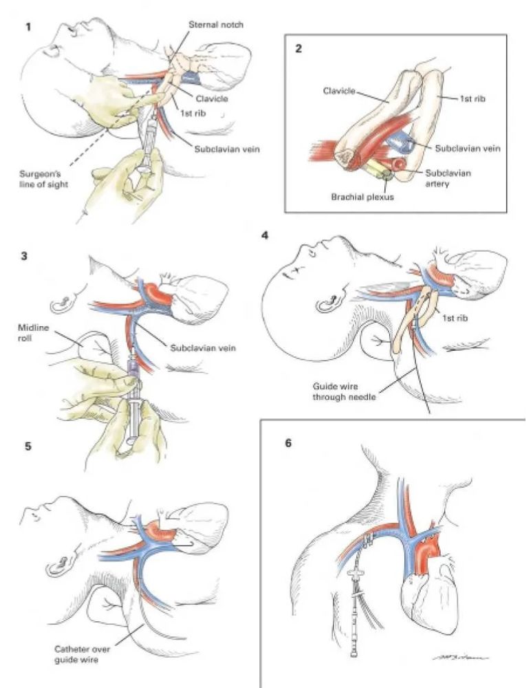颈内静脉注入头臂静脉图片