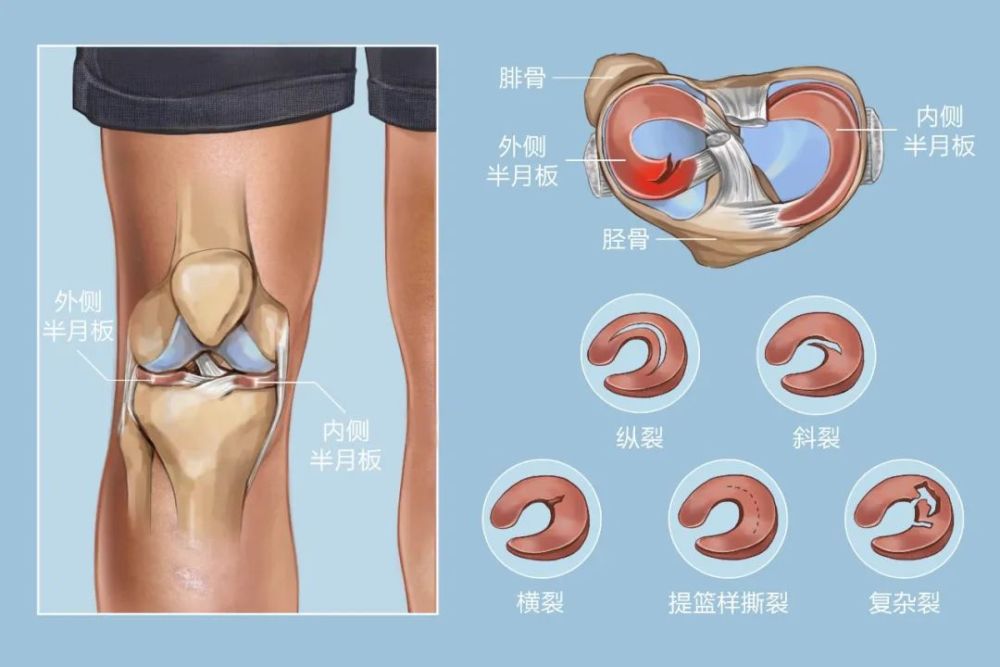 郴州骨科醫院提醒膝蓋卡卡腫痛是半月板在抗議請引起重視