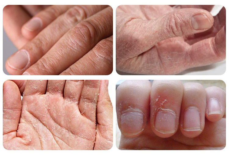 加上大风一吹,那皮肤就跟风干了的橘皮一样,皱巴又枯黄.