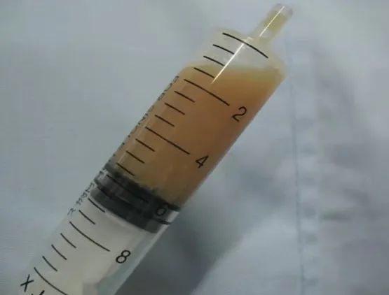 乳糜性胸水咋确定