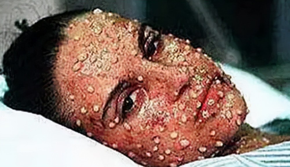 这时候人基本上就成了一个"脓球",根本动都不能动,一动皮肤就会破溃