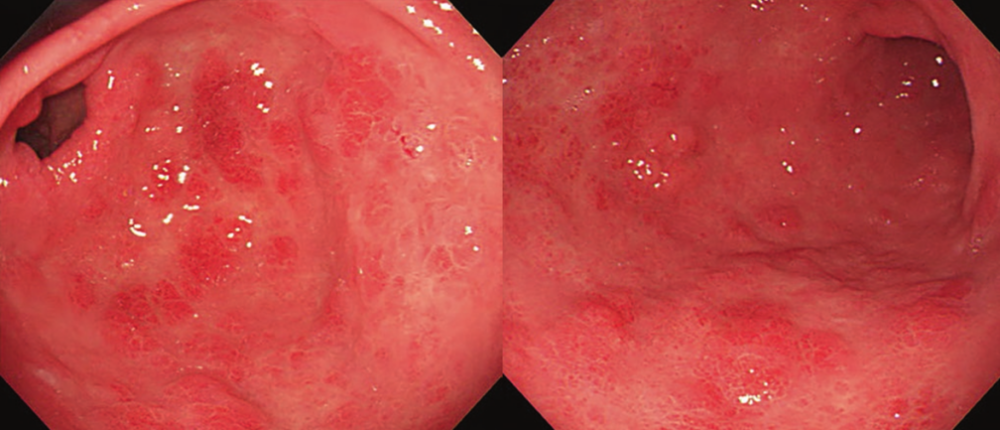 发现胃息肉如何区分一文搞定胃息肉的分类