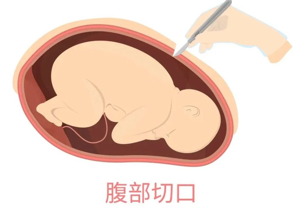 剖宫产3年后月经竟然跑到肚皮上