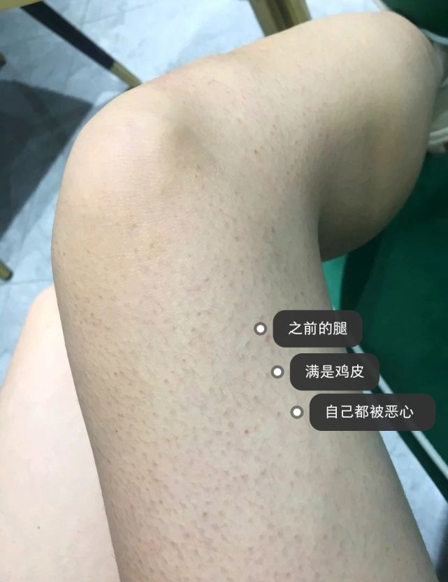 鸡皮肤用水杨酸起皮(鸡皮肤用水杨酸起皮怎么办)