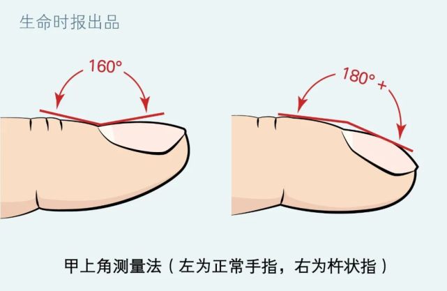 杵状指的测量方法图片