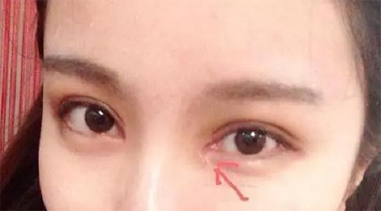 内眼角开太大了怎么办,修复内眼角眼睛会不会变小?