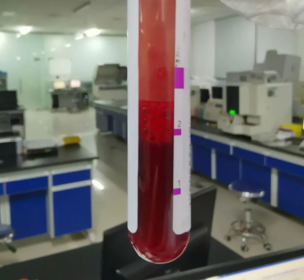 有泡沫的血液标本你注意了吗