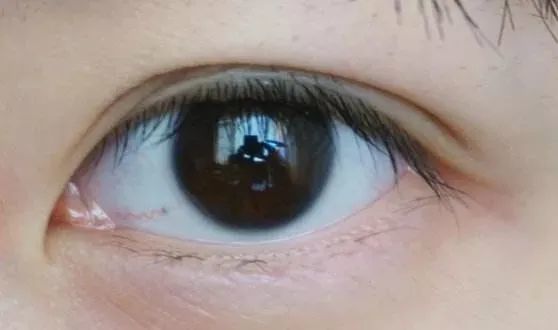 做完双眼皮后,眼头或眼尾多出一条褶皱,这正常吗?插图