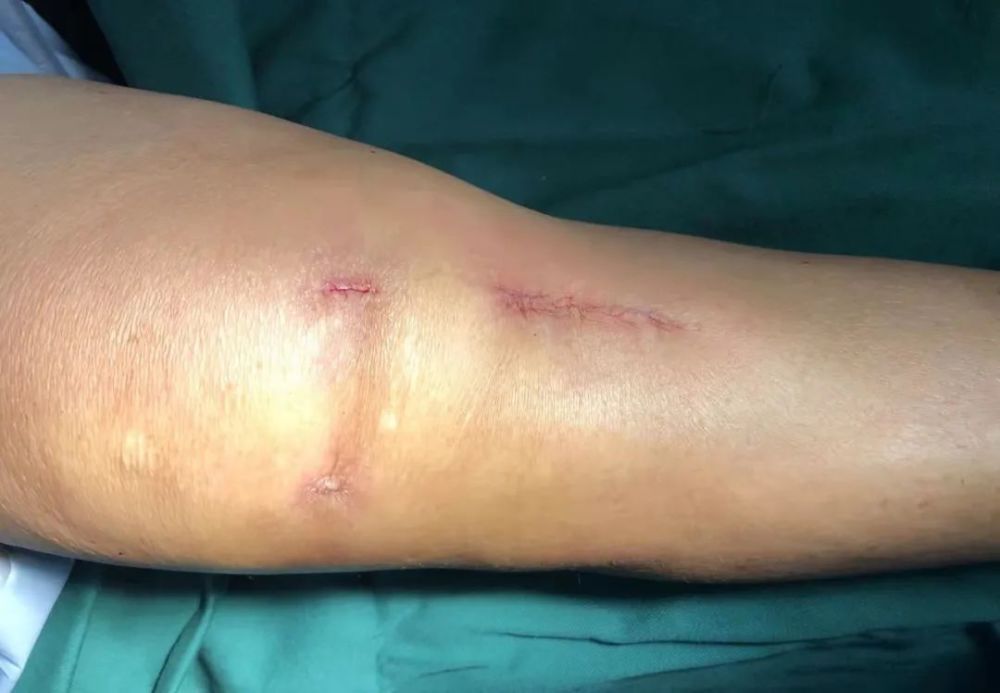 施术团队和手术切口近日,儋州市人民医院骨二科主任向湘松在麻醉手术