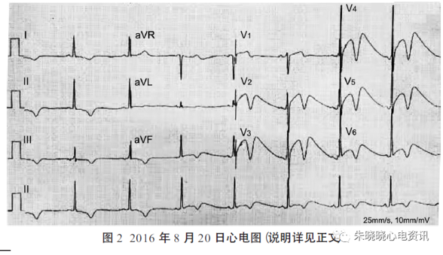 显著颠簸样三相t波|心电图|导联|心律失常|心脏