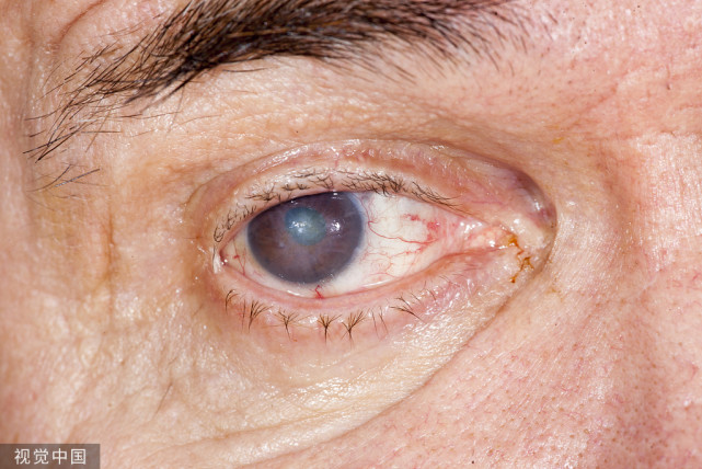 对眼睛来说,长期高血糖将会导致视网膜血管病变,也就是糖网病,会引起