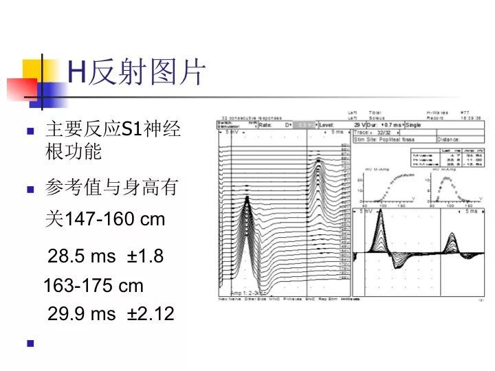 臨床筆記|一文讀懂:肌電圖的機制和應用基礎